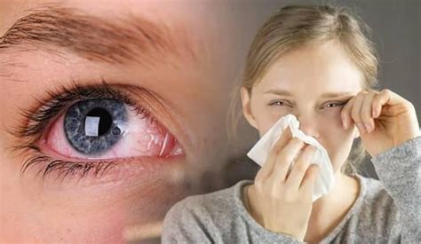 grip ve göz nezlesi nasıl geçer